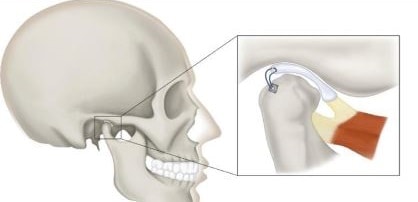 TMJ Surgery Procedures​