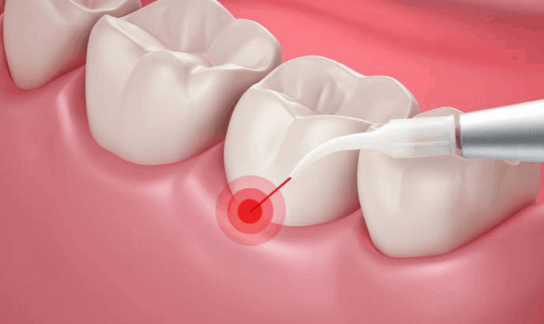 Best Treatments for gum diseases in Memphis