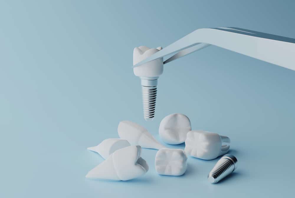 Zirconia Dental Implants or Titanium Dental Implants? Which are best for me?