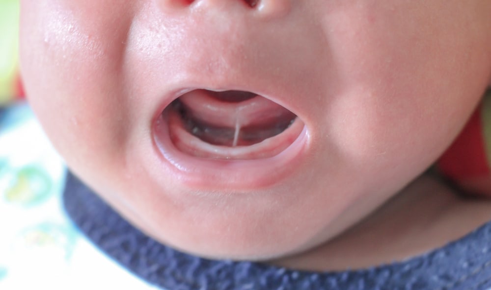 Tongue Tie Condition In Infants
