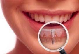 Same Day Dental Implants in Cordova, TN