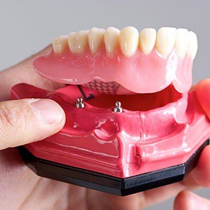 all on 4 dental implants in memphis, TN