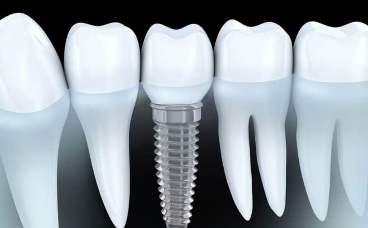  10 Dental Implant Facts You May Not Be Aware Of