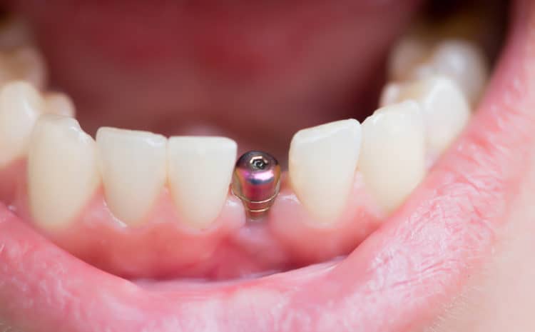  Healing & Recovery Strategies for Dental Implants: A Deep Dive