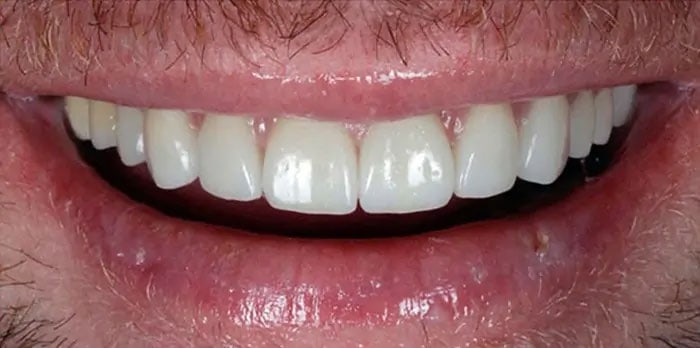 Dr. Adatrow's Patient After Smile Rehabilitation with Dental Implants