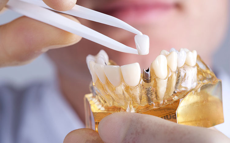  How long do dental implants last