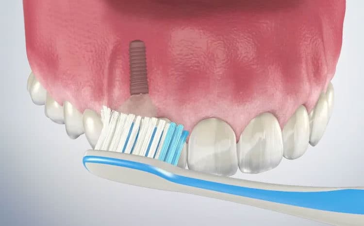  7 Dental Implant Home Care Tips – Dos and Don’ts