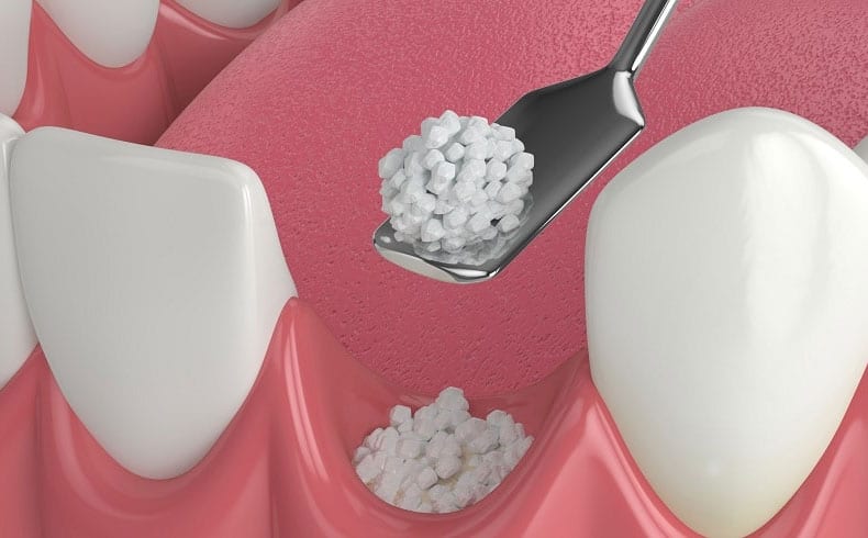  6 Reasons to Consider Dental Bone Grafts for Implants