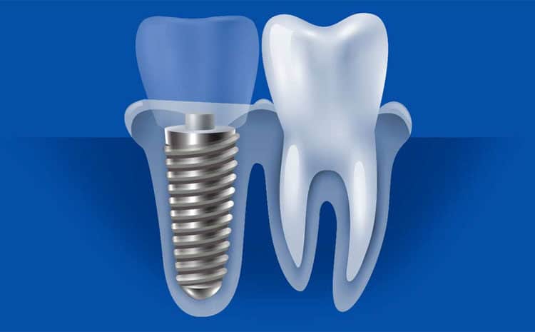  Titanium Dental Implants: 8 Fantastic Reasons to Choose