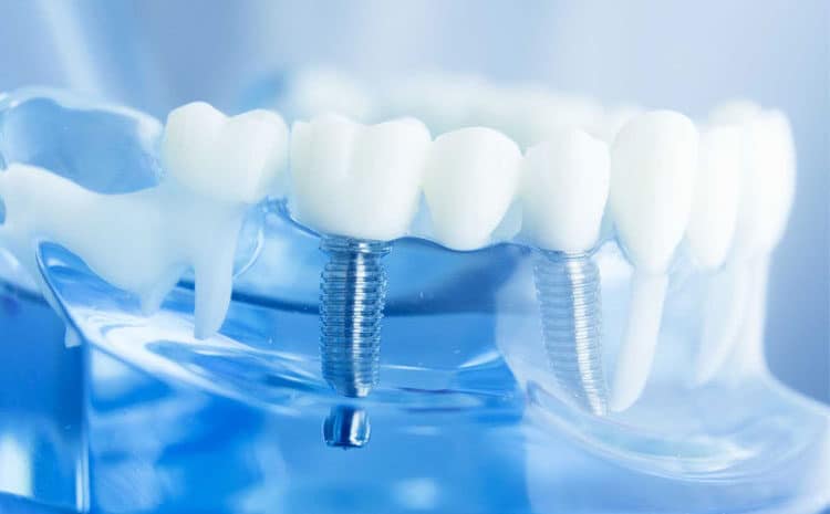  What Are Dental Implants Made Of?