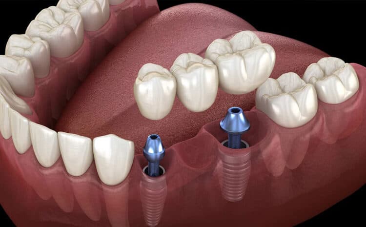  After Care of Dental Implants