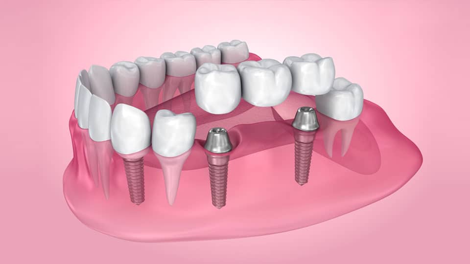  Affordable Permanent DentaI Implants