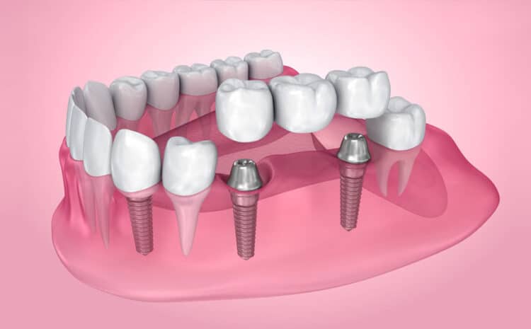  Affordable Permanent DentaI Implants