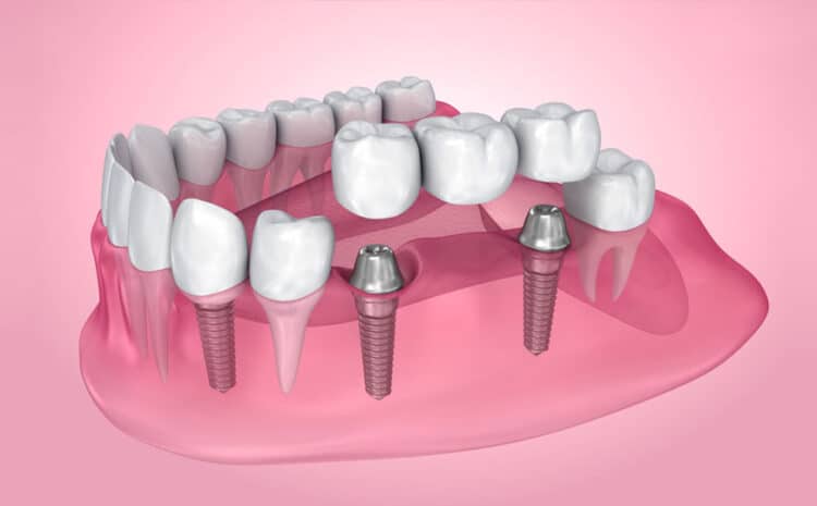  Affordable Permanent DentaI Implants