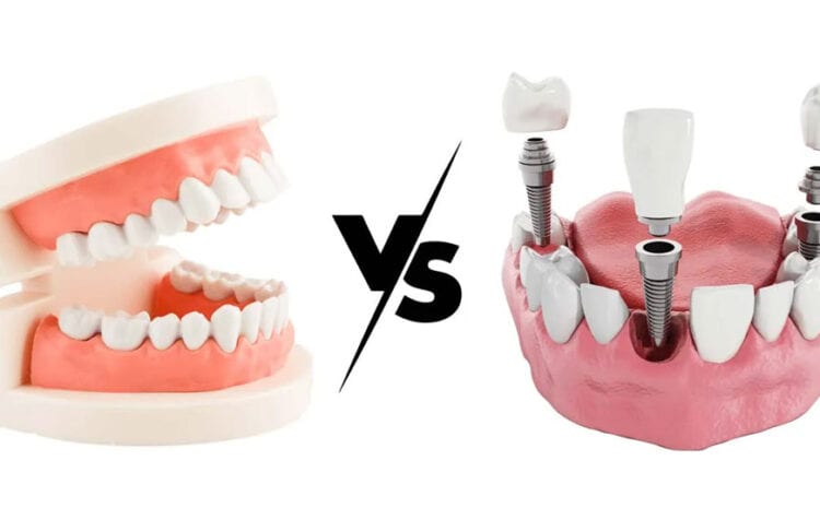  Dental Implants or Dentures