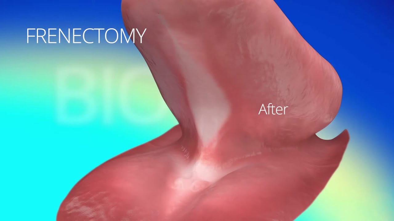  Before and After the Dental Implant Procedure