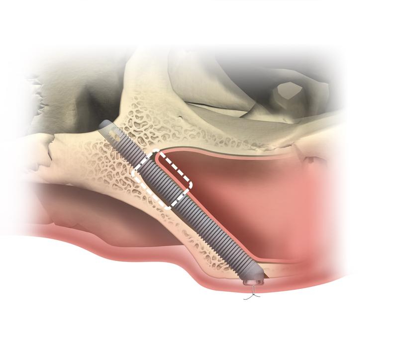 Zygomatic Dental Implants in Memphis