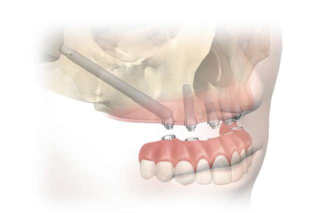 Zygomatic Dental Implants in Memphis