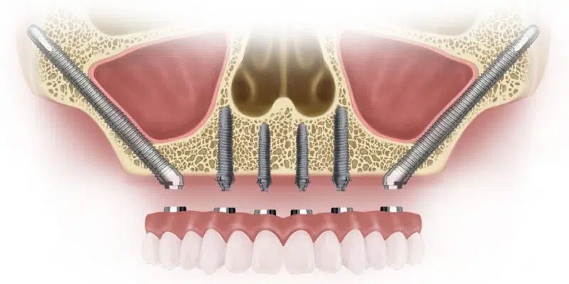 Zygomatic Dental Implants in Memphis