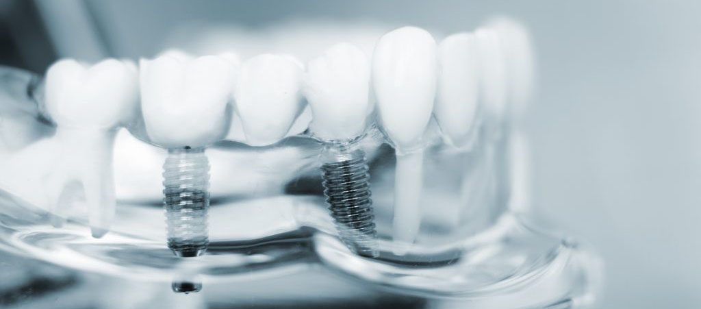 Bruxism & Dental Implants | Protect Your Implants from Night Grinding