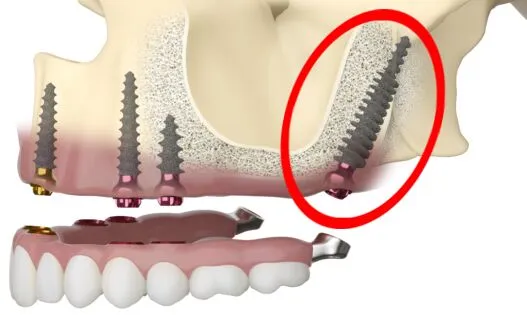 pterygoid dental implants Memphis CBCT scan

