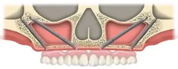 pterygoid dental implants Memphis CBCT scan


