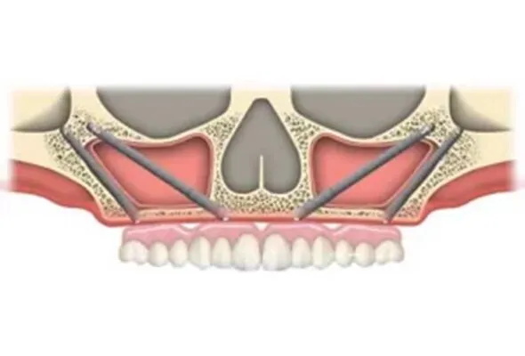 advanced dental pterygoid implant procedure