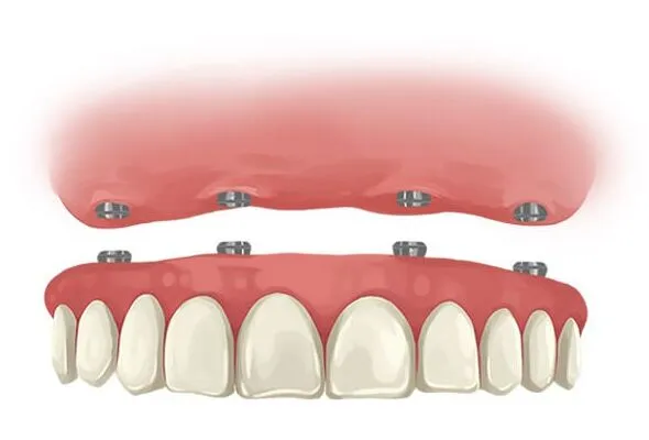patient receiving pterygoid implant in Southaven