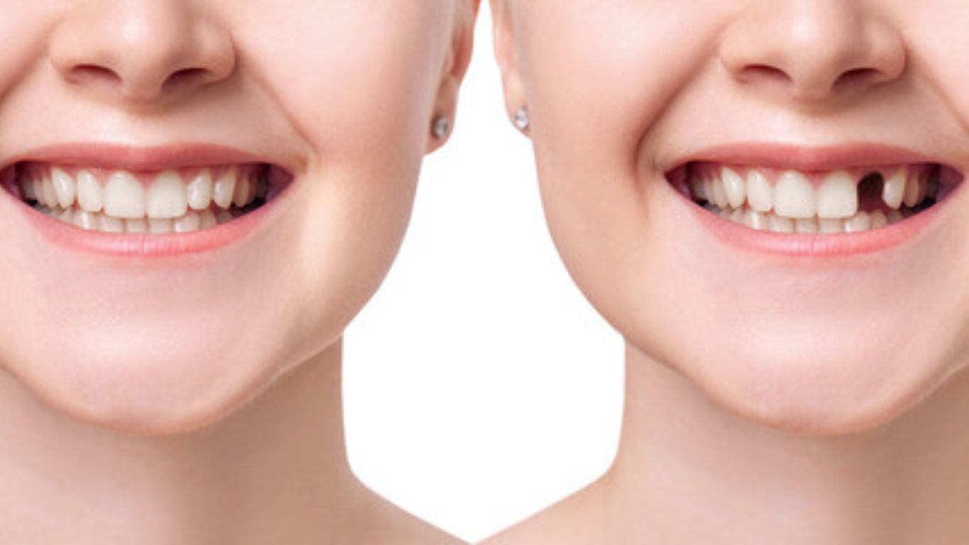  Immediate vs. Delayed Implants After Extraction: Who Qualifies?