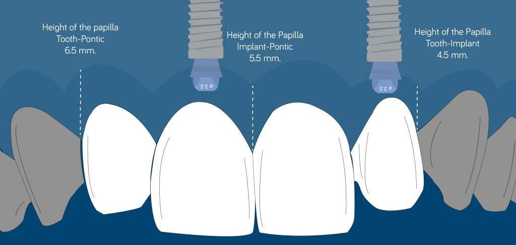  Esthetics in the Smile Zone: Managing Papilla & Midline – What Patients Don’t See in Photos