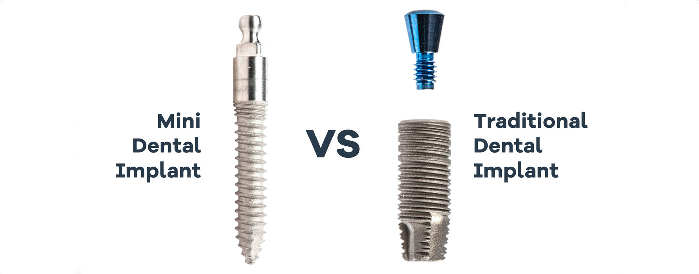  Mini Implants vs. Standard Implants for Dentures: Where Minis Still Make Sense (and Where They Don’t)