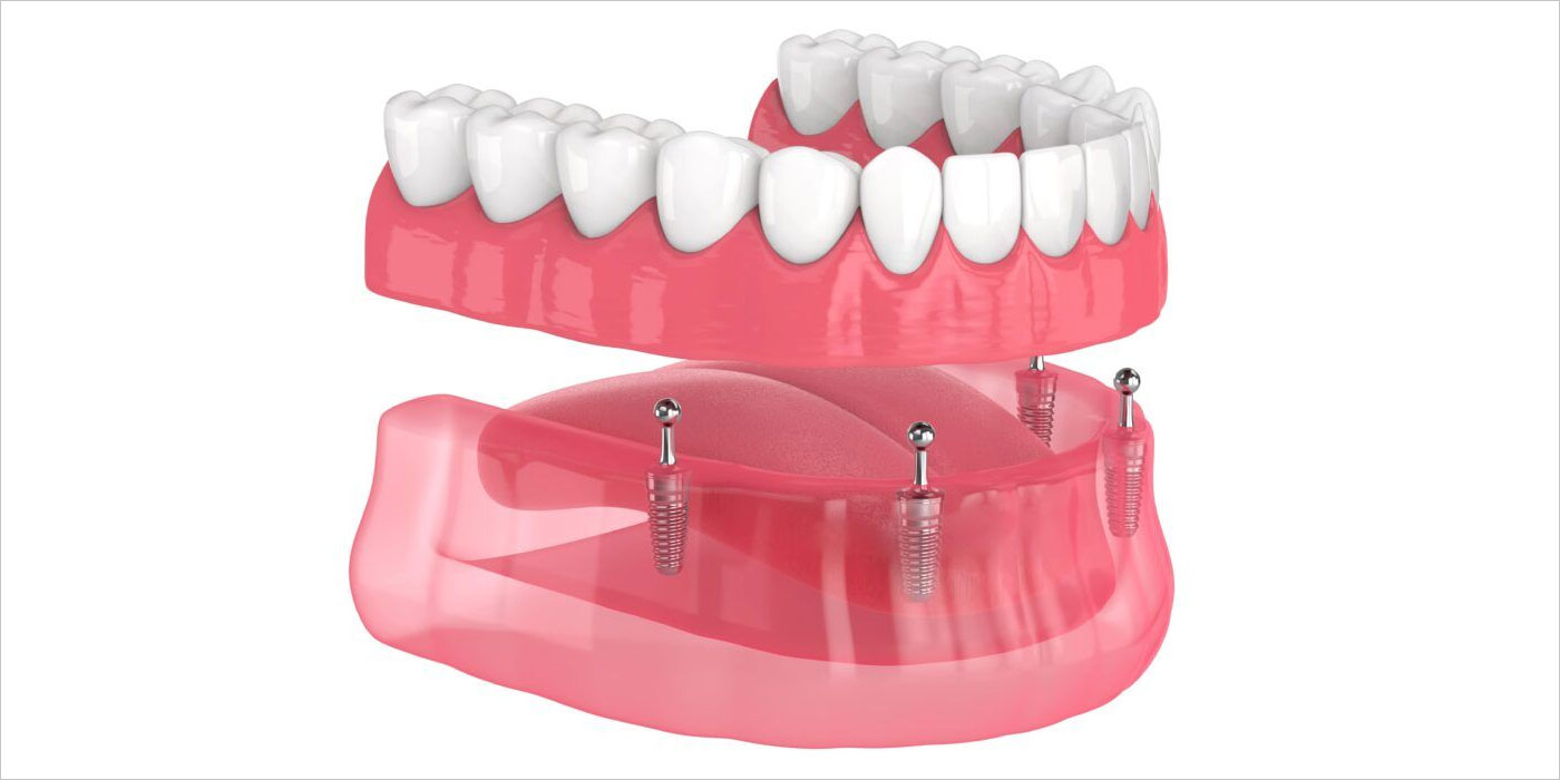  Overdenture Attachments Explained: Locator vs. Bar vs. Milled Hybrid Conversion