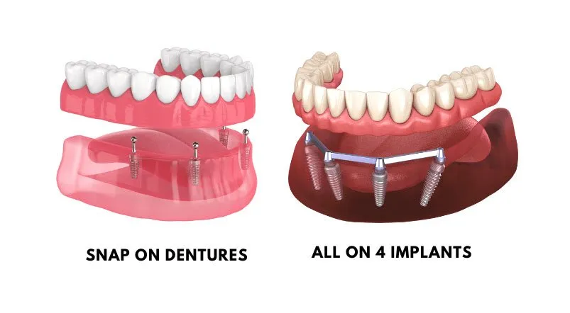  All-on-X vs. Snap-On Dentures | Full-Arch Dental Implant Comparison 2025