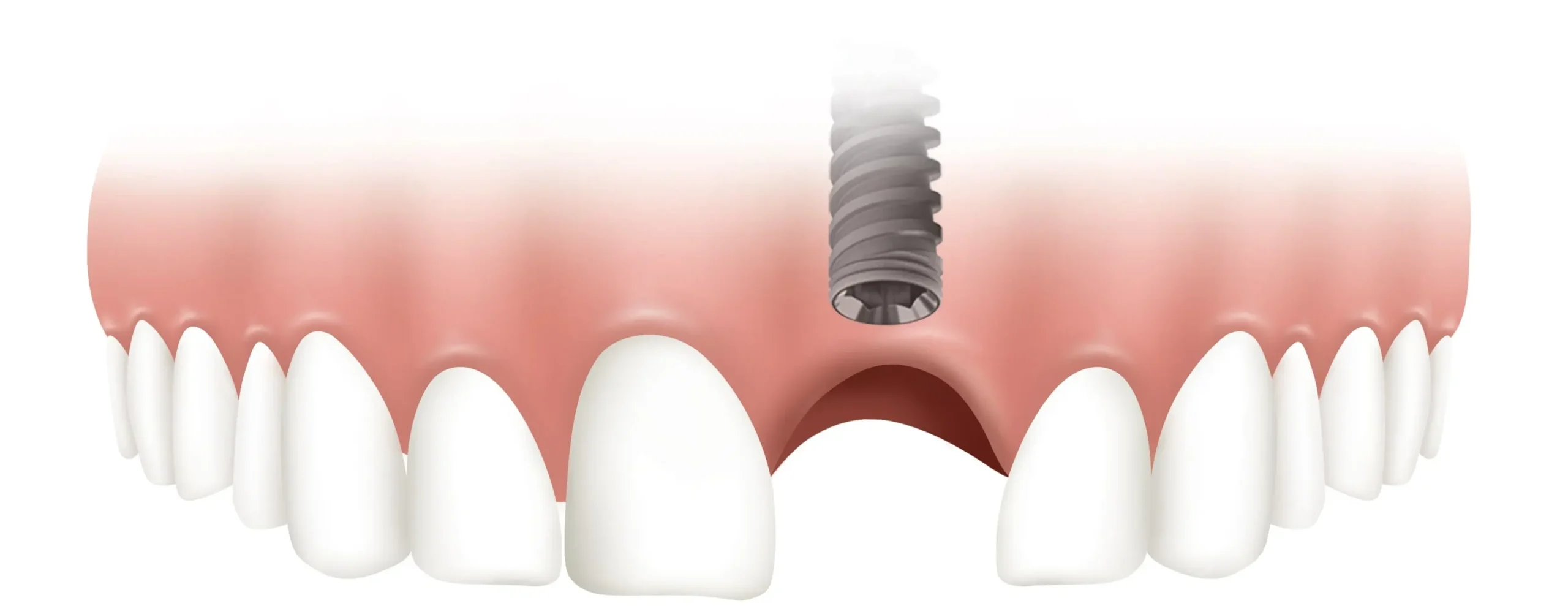  Keratinized Tissue for Dental Implants | Gum Graft & Soft Tissue Health