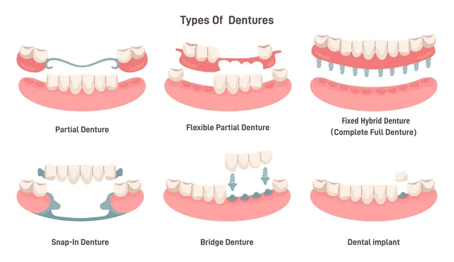  10-Year Cost Comparison – Fixed Hybrid vs. Overdenture vs. Traditional Denture | Dr. Adatrow