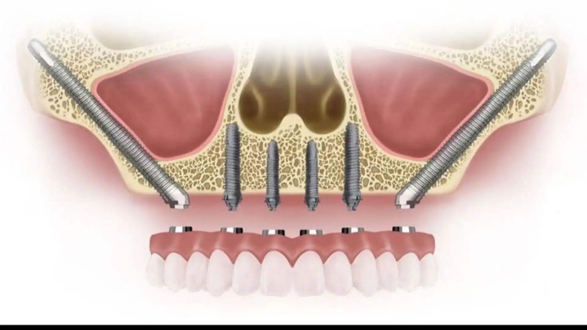  Sinus Lift vs. Crestal vs. Zygomatic Implants | Expert Guide by Dr. Adatrow