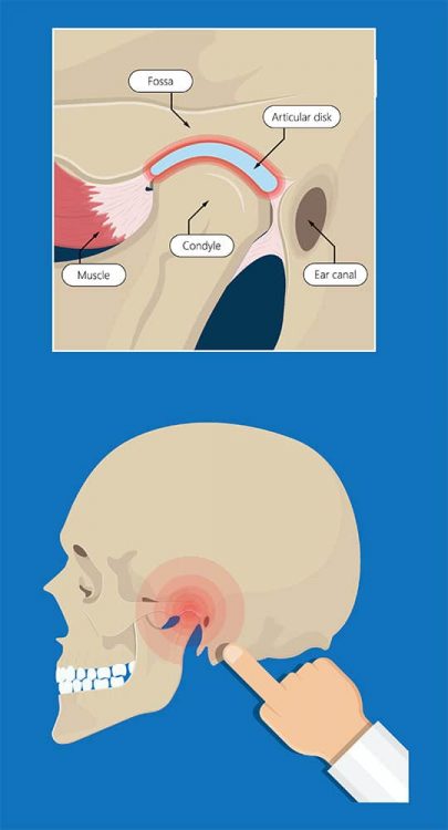 Top 10 Causes of TMJ